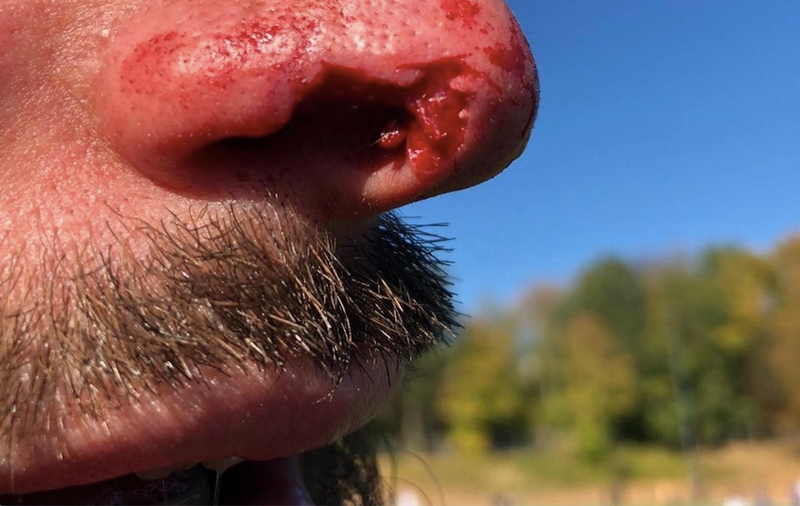 Illustration for article titled German Soccer Player Bites Off (And Maybe Eats?) Chunk Of Opponent's Nose